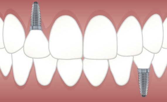implant
